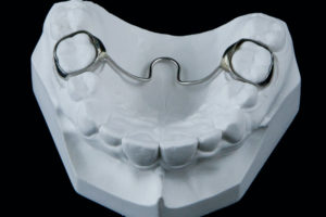 Trans Palatal Arch Appliance