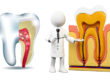 root-canal-treatment-in-rt-nagar